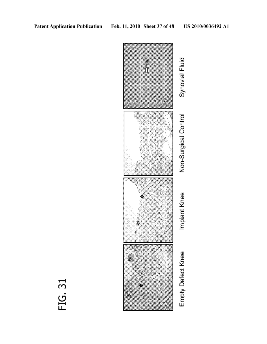 OSTEOCHONDRAL IMPLANTS, ARTHROPLASTY METHODS, DEVICES, AND SYSTEMS - diagram, schematic, and image 38