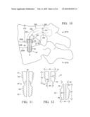 Device and method for treating spine diagram and image