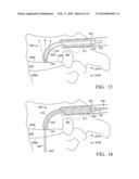 Device and method for treating spine diagram and image