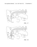 Device and method for treating spine diagram and image