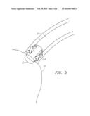 Fallopian Tube Occlusion Devices and Methods diagram and image