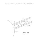 Fallopian Tube Occlusion Devices and Methods diagram and image