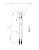 Safety Biopsy Instrument diagram and image