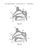 DEVICES, SYSTEMS AND METHODS USEABLE FOR TREATING SINUSITIS diagram and image