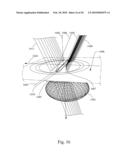 Method and System for Removal and Replacement of Lens Material fron the Lens of an Eye diagram and image