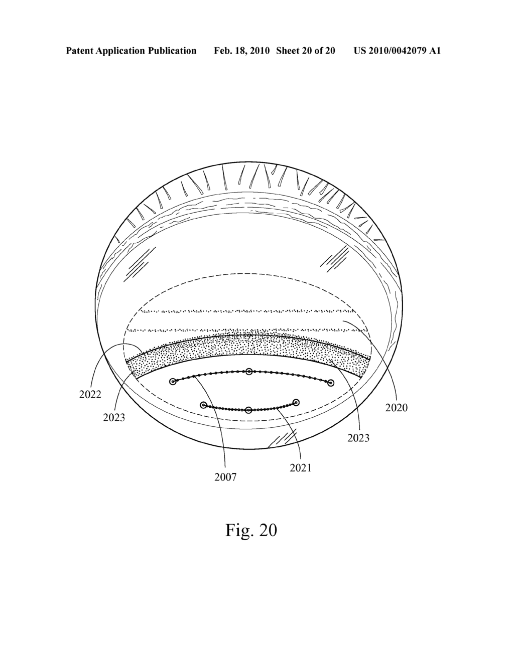 Method and System for Removal and Replacement of Lens Material fron the Lens of an Eye - diagram, schematic, and image 21