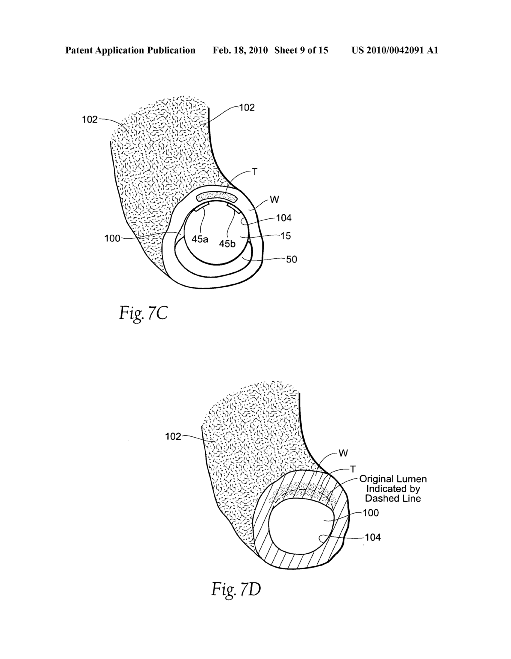 Surgical instruments and techniques for treating gastro-esophageal reflux disease - diagram, schematic, and image 10