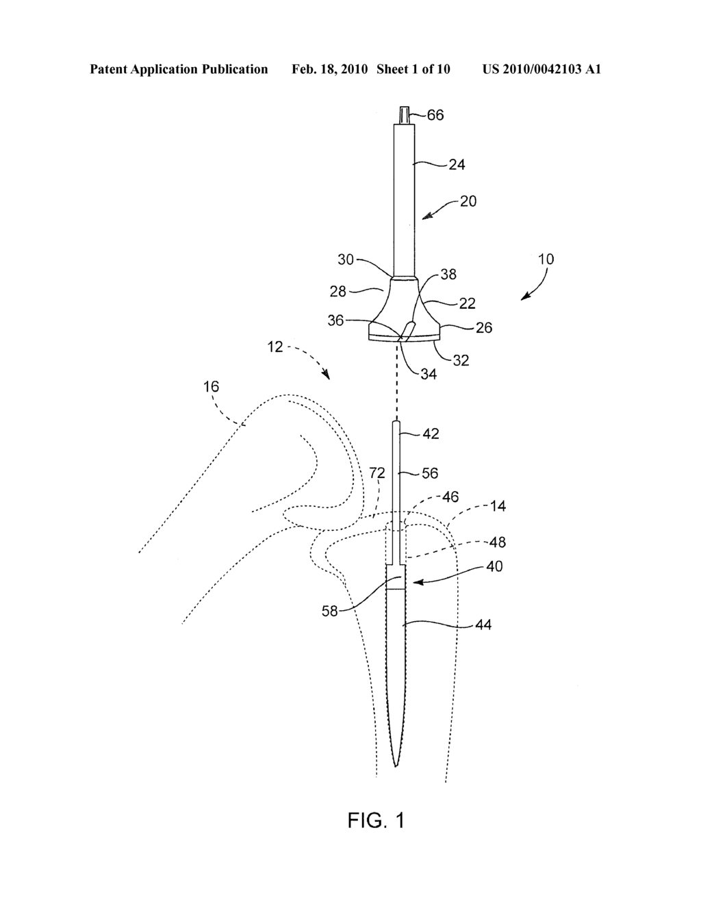 SYSTEMS AND METHODS FOR PROVIDING A BONE MILLING DEVICE - diagram, schematic, and image 02