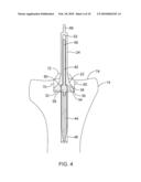 SYSTEMS AND METHODS FOR PROVIDING A BONE MILLING DEVICE diagram and image