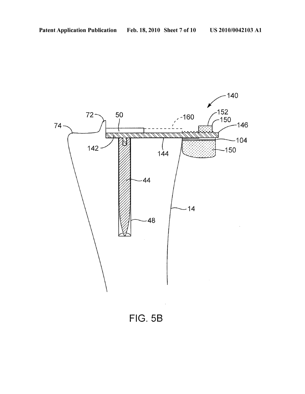 SYSTEMS AND METHODS FOR PROVIDING A BONE MILLING DEVICE - diagram, schematic, and image 08