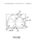 Arthroplasty system and related methods diagram and image