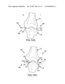 Arthroplasty system and related methods diagram and image