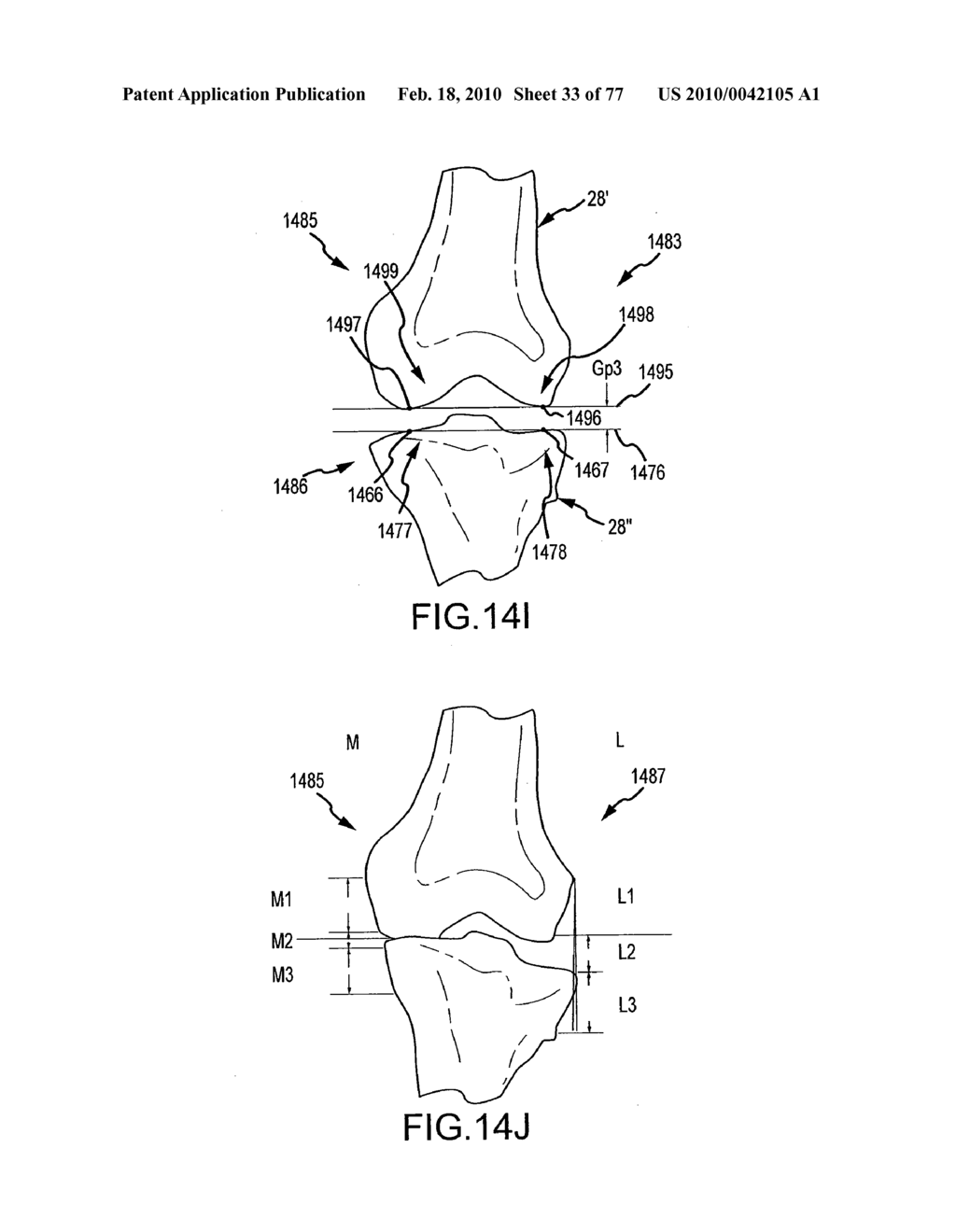 Arthroplasty system and related methods - diagram, schematic, and image 34