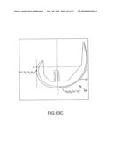 Arthroplasty system and related methods diagram and image