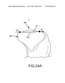 Arthroplasty system and related methods diagram and image