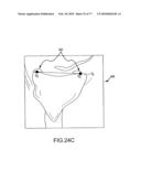 Arthroplasty system and related methods diagram and image