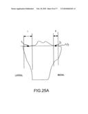 Arthroplasty system and related methods diagram and image