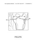 Arthroplasty system and related methods diagram and image