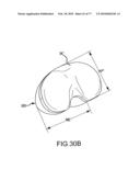 Arthroplasty system and related methods diagram and image