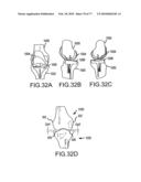 Arthroplasty system and related methods diagram and image