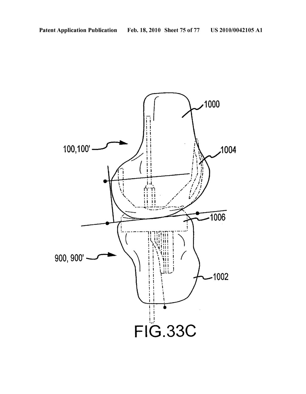 Arthroplasty system and related methods - diagram, schematic, and image 76