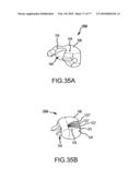 Arthroplasty system and related methods diagram and image