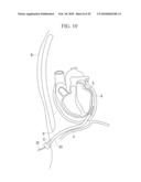 METHOD OF CARDIAC SURGERY, AND DEFIBRILLATION ELECTRODE, DEFIBRILLATOR, AND ENDOSCOPE APPARATUS FOR THE SAME diagram and image