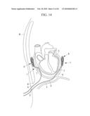 METHOD OF CARDIAC SURGERY, AND DEFIBRILLATION ELECTRODE, DEFIBRILLATOR, AND ENDOSCOPE APPARATUS FOR THE SAME diagram and image