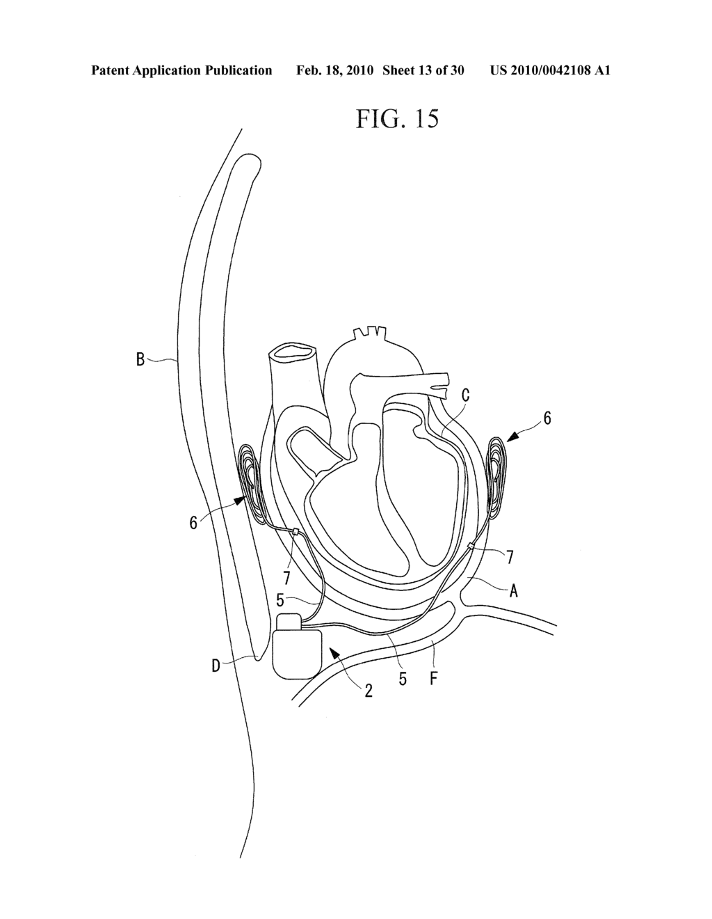 METHOD OF CARDIAC SURGERY, AND DEFIBRILLATION ELECTRODE, DEFIBRILLATOR, AND ENDOSCOPE APPARATUS FOR THE SAME - diagram, schematic, and image 14