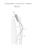 METHOD OF CARDIAC SURGERY, AND DEFIBRILLATION ELECTRODE, DEFIBRILLATOR, AND ENDOSCOPE APPARATUS FOR THE SAME diagram and image