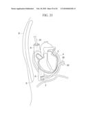 METHOD OF CARDIAC SURGERY, AND DEFIBRILLATION ELECTRODE, DEFIBRILLATOR, AND ENDOSCOPE APPARATUS FOR THE SAME diagram and image