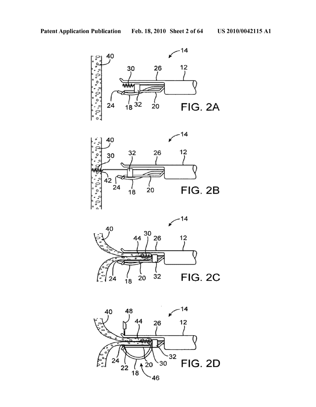 NEEDLE ASSEMBLY FOR TISSUE MANIPULATION - diagram, schematic, and image 03