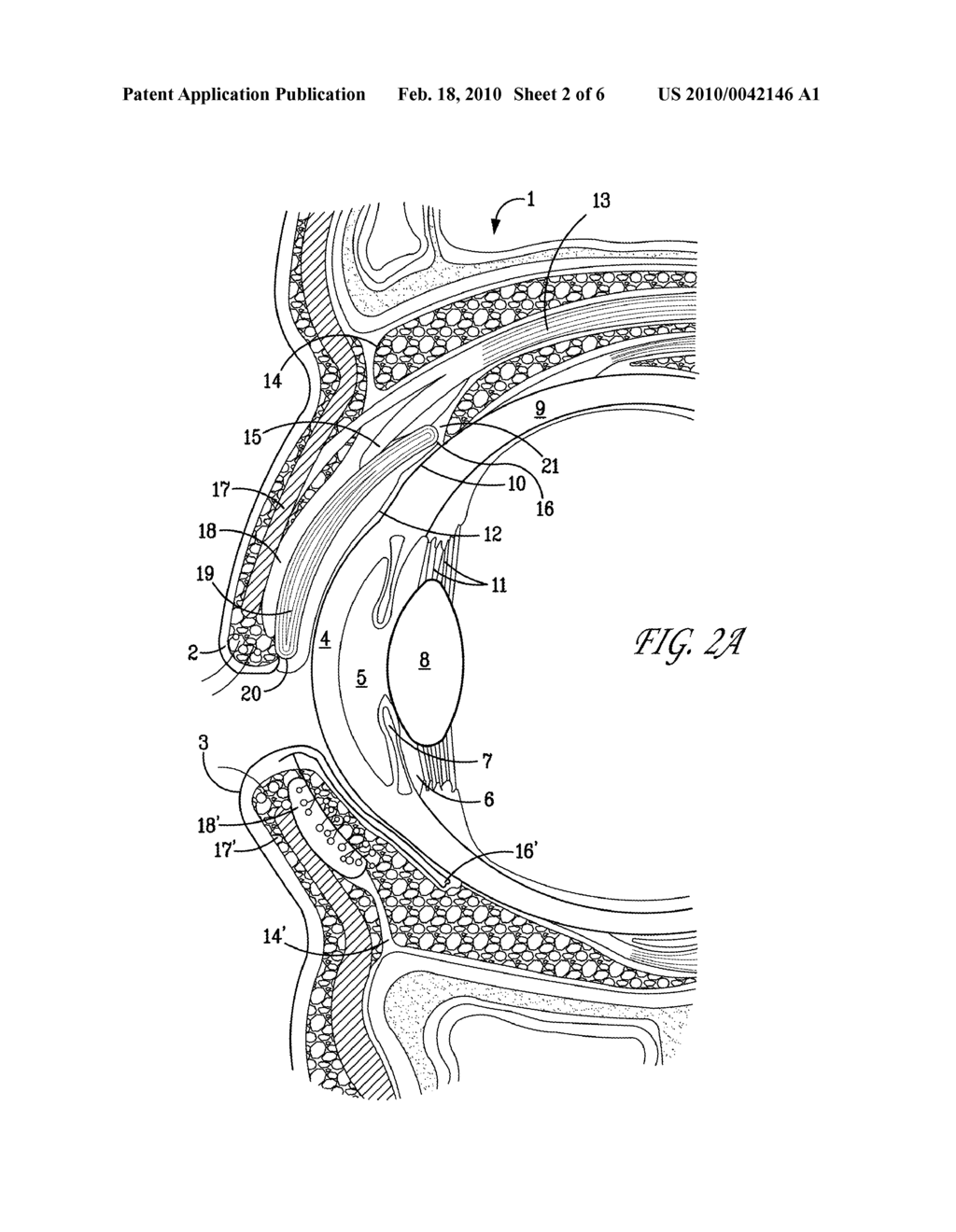 SURGICAL CORRECTION OF PTOSIS BY POLYMERIC ARTIFICIAL MUSCLES - diagram, schematic, and image 03