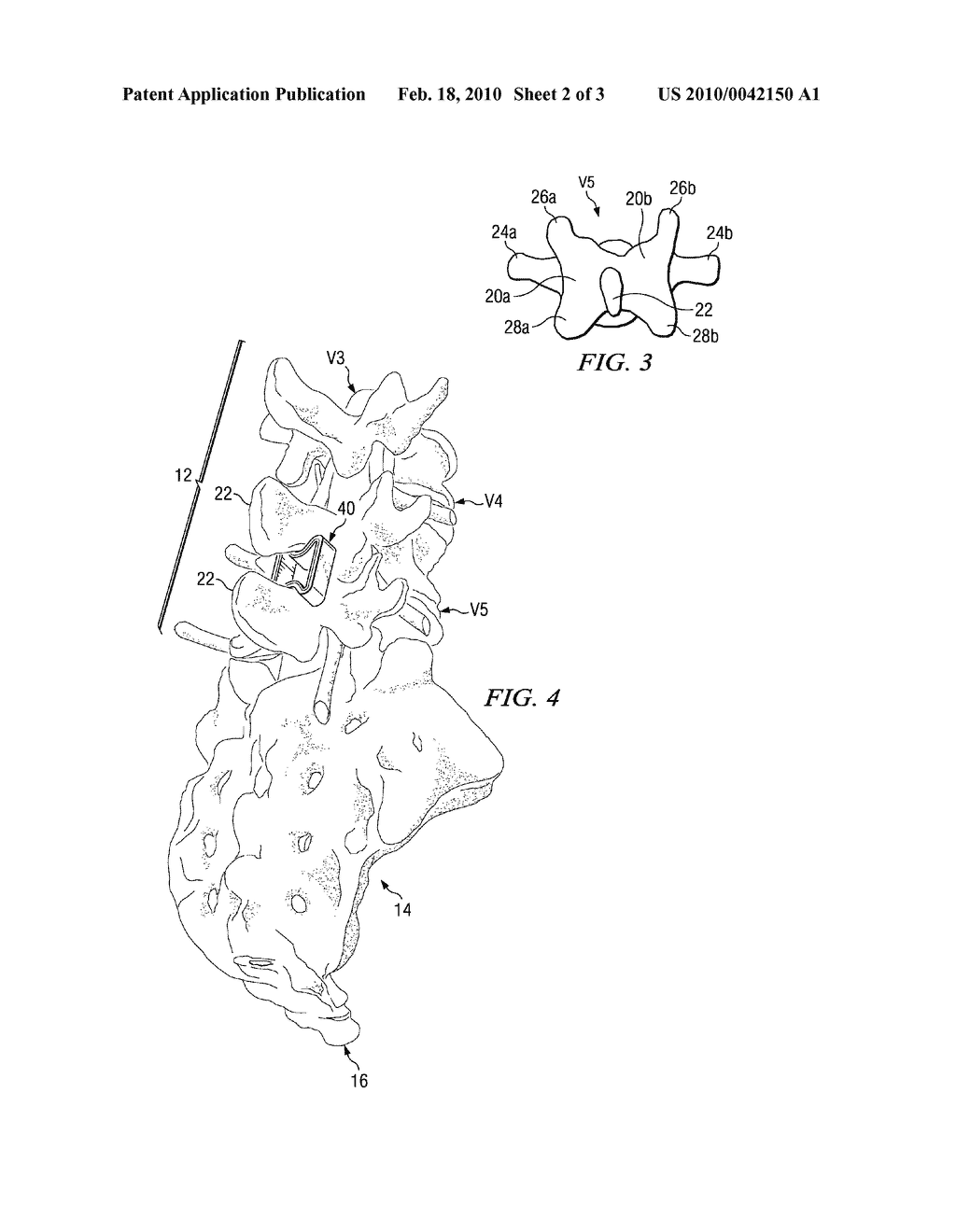 INTERVERTEBRAL PROSTHETIC DEVICE FOR SPINAL STABILIZATION AND METHOD OF MANUFACTURING SAME - diagram, schematic, and image 03