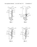 SELF-LOCKING SURGICAL FASTENER diagram and image