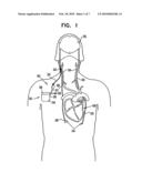 Electrode devices for nerve stimulation and cardiac sensing diagram and image