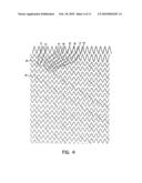 Self-Expanding Stent diagram and image