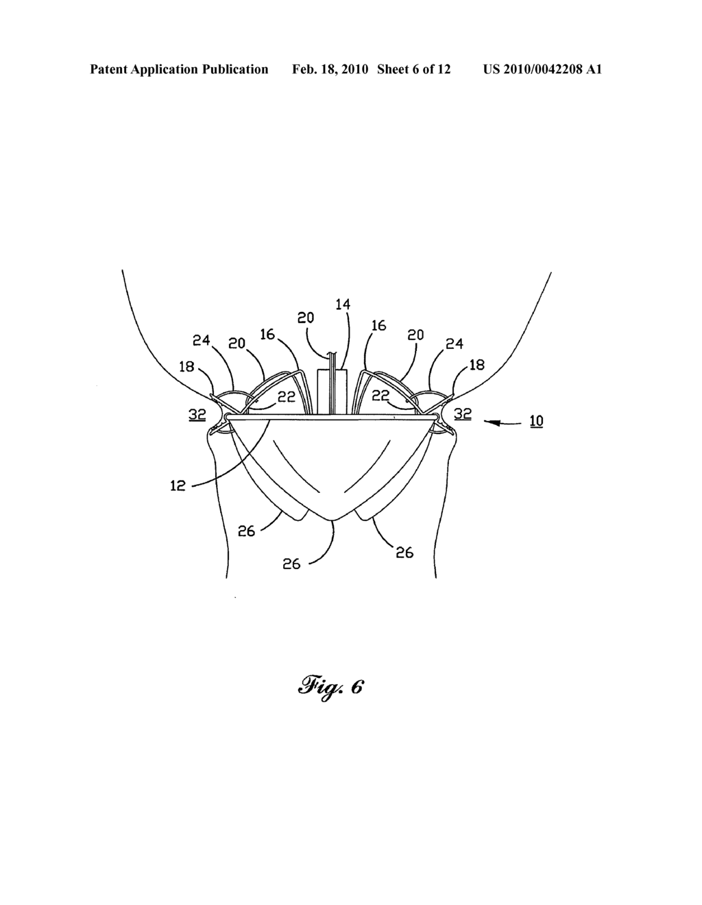 Percutaneous Heart Valve - diagram, schematic, and image 07