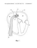 Percutaneous Heart Valve diagram and image