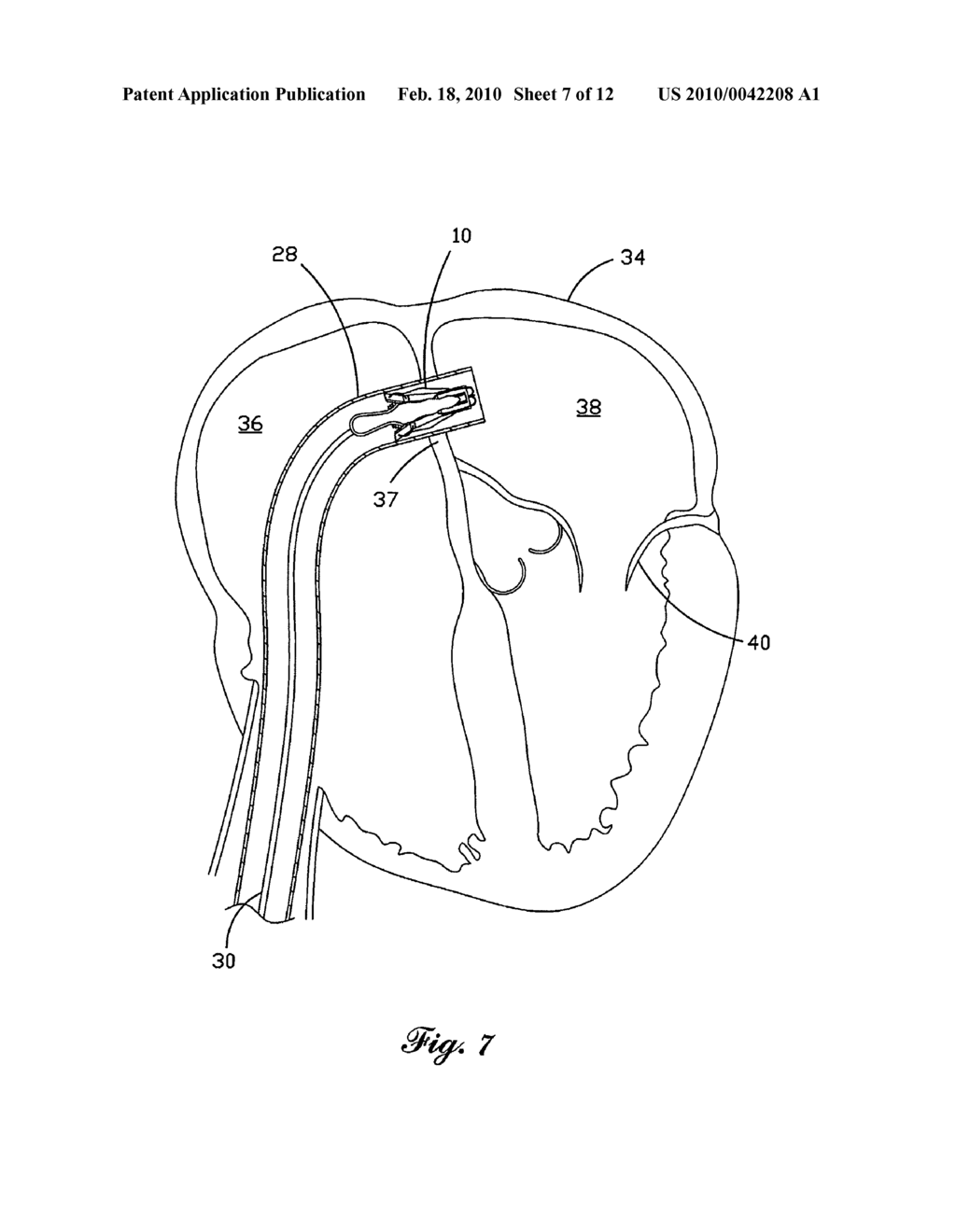 Percutaneous Heart Valve - diagram, schematic, and image 08