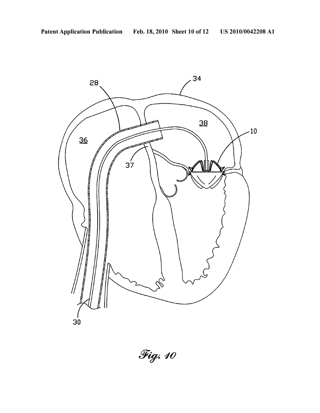 Percutaneous Heart Valve - diagram, schematic, and image 11