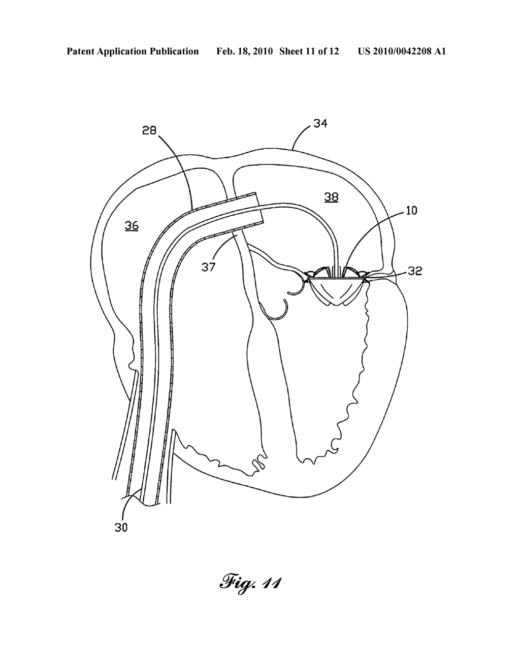 Percutaneous Heart Valve - diagram, schematic, and image 12