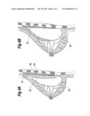 SOFT FILLED PROSTHESIS SHELL WITH DISCRETE FIXATION SURFACES diagram and image