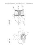 BONE FIXATION SURFACES FOR INTERVERTEBRAL IMPLANTS diagram and image