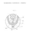 Maxillary Sinus Bone Graft Method Using the Sinus Lift Drill (SLD) and Hydraulic Effect diagram and image