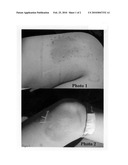 Treatments for burns using thyroid hormone compound in a human diagram and image