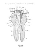 Apparatus and methods for treating tooth root canals diagram and image