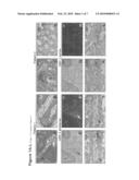 METHOD FOR THE DETECTION OF INTERFERON-ASSOCIATED ANGIOSTATIC TUMORSTAGES IN COLORECTAL CARCINOMA diagram and image