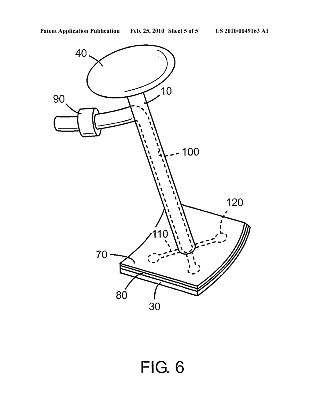 Drug delivery device, kit and method for peroperative local pharmacological treatment of bone surfaces - diagram, schematic, and image 06