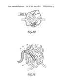 DETACHABLE TIP MICROCATHETER diagram and image